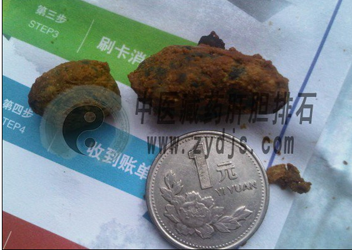 济南王女士利用“胆结石自然疗法”排出硬币大小“巨石”